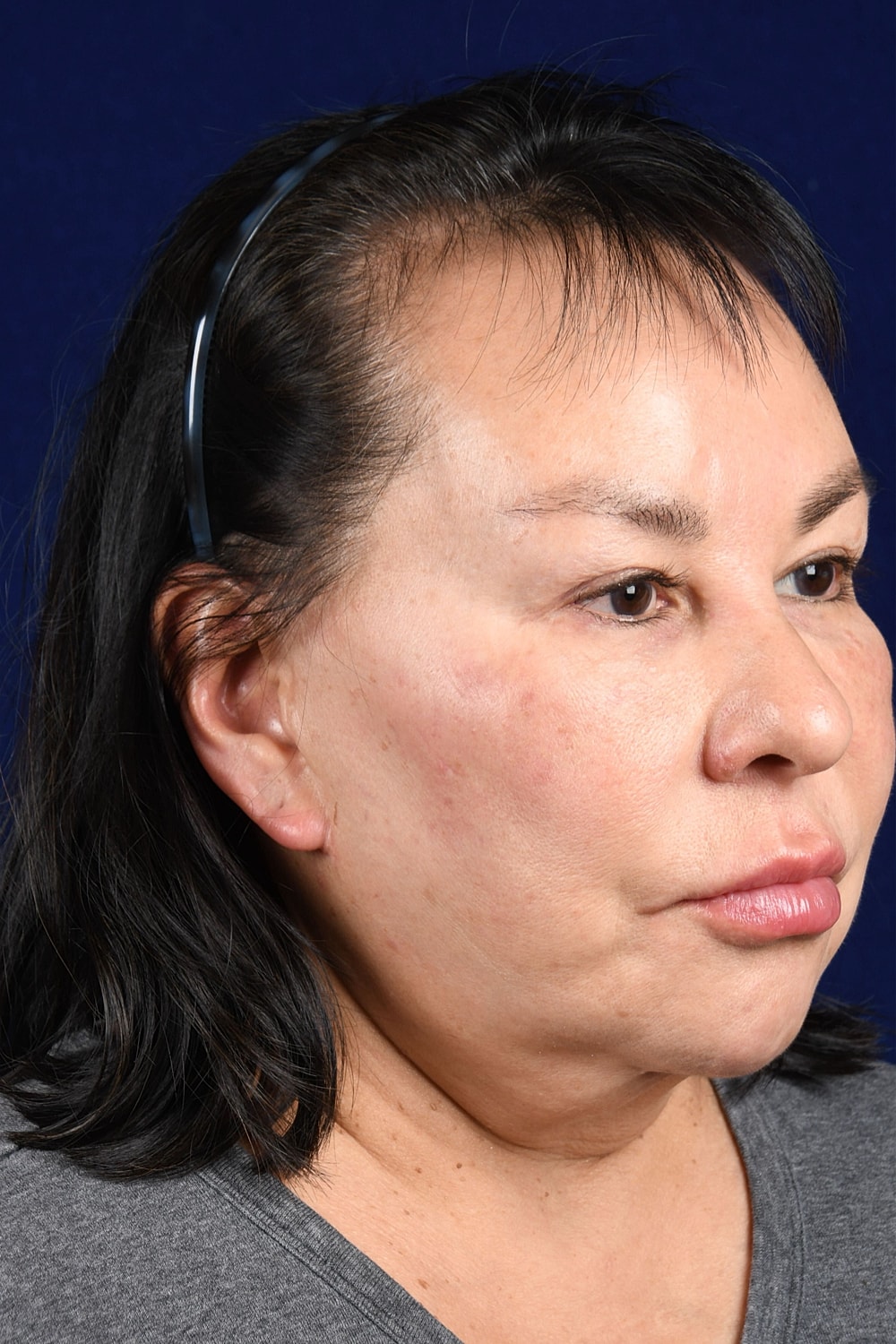 Facial Rejuvenation Before & After