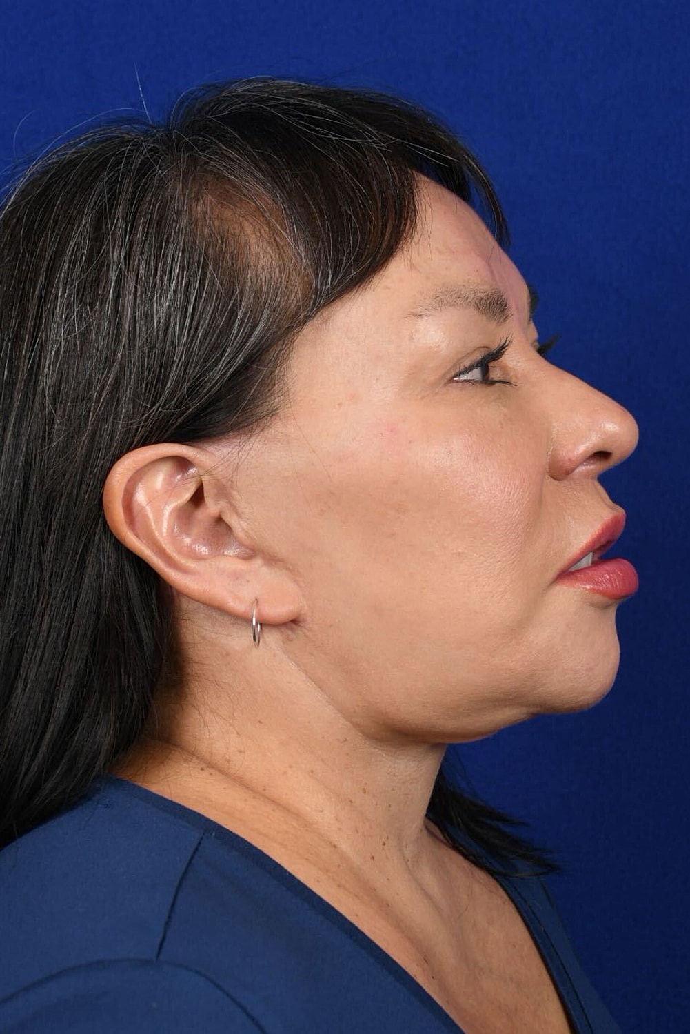 Facial Rejuvenation Before & After