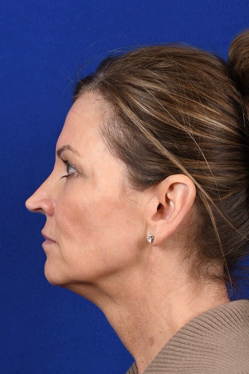 Facial Rejuvenation Before & After