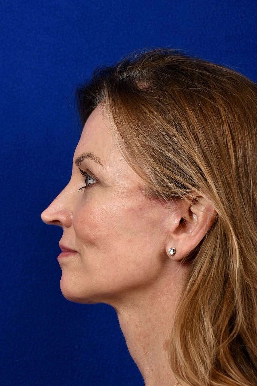 Facial Rejuvenation Before & After