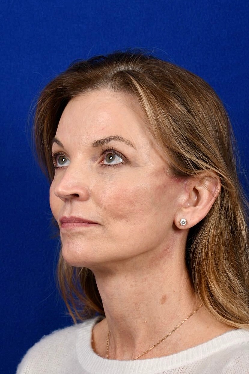 Facial Rejuvenation Before & After