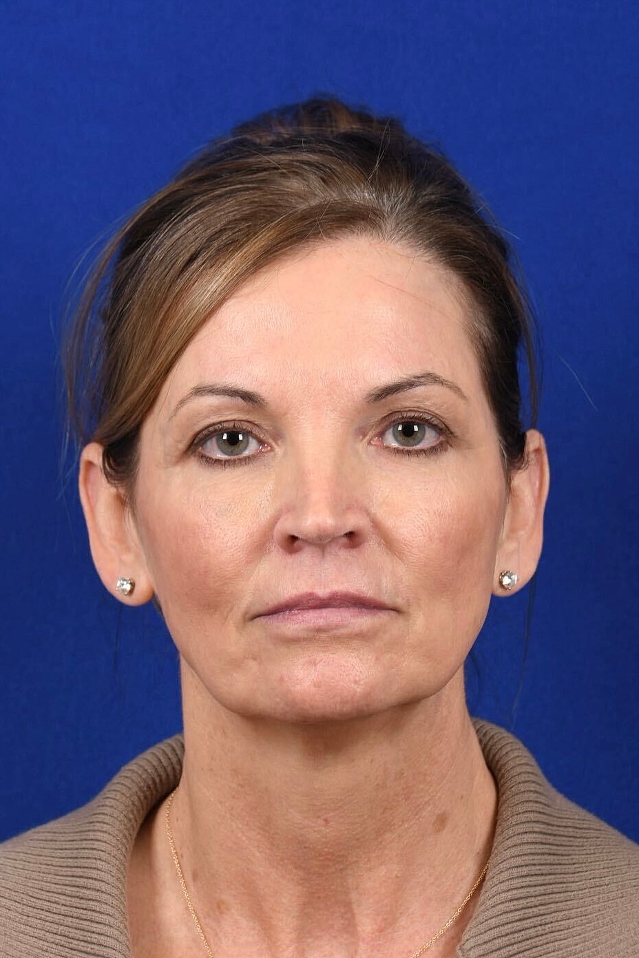 Facial Rejuvenation Before & After