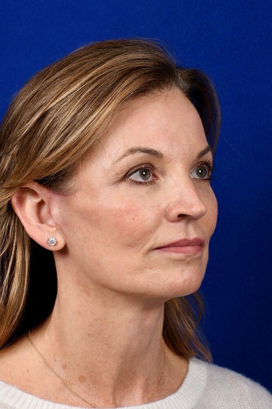 Facial Rejuvenation Before & After