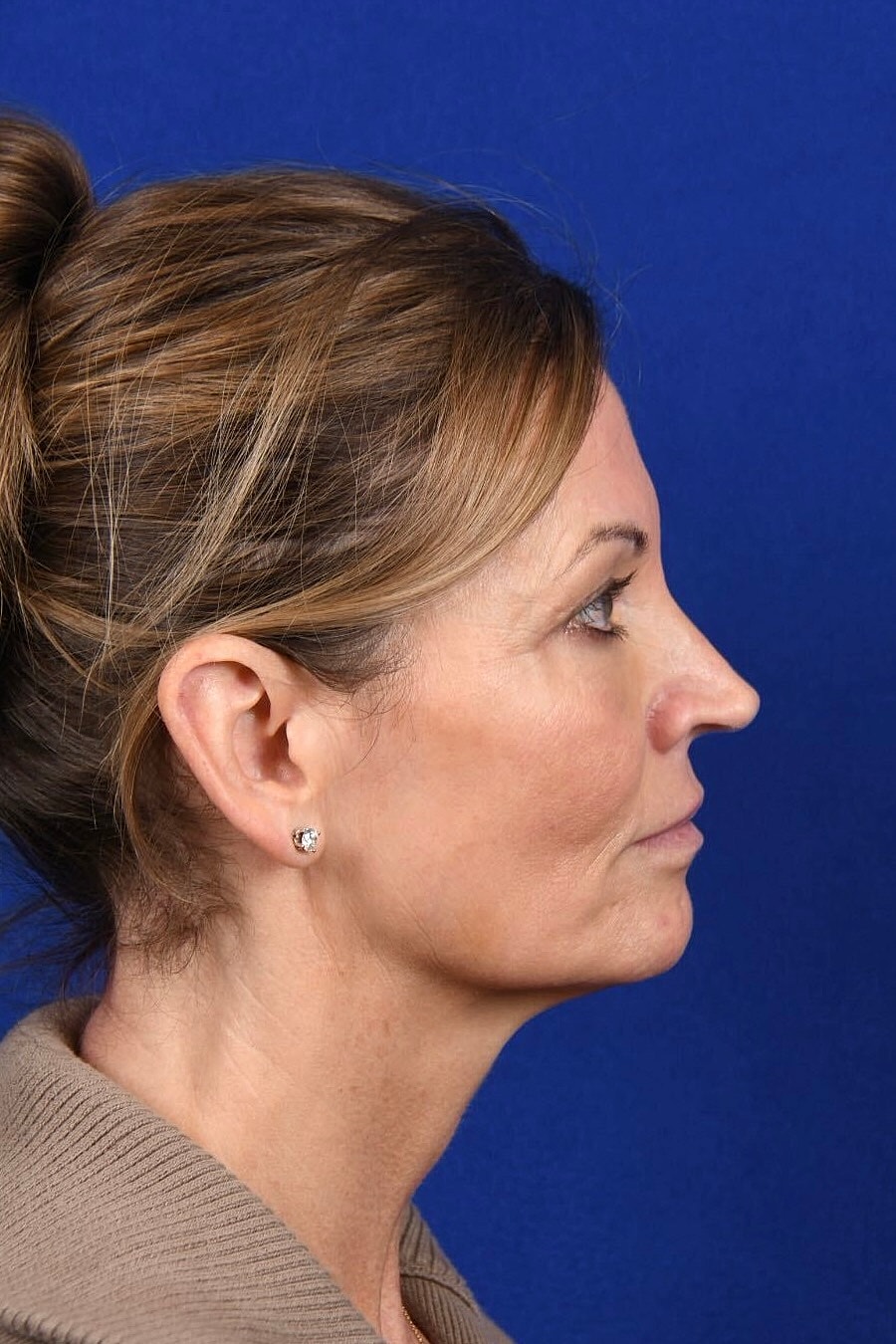Facial Rejuvenation Before & After