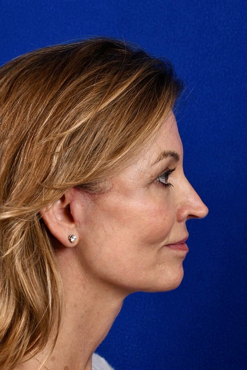 Facial Rejuvenation Before & After