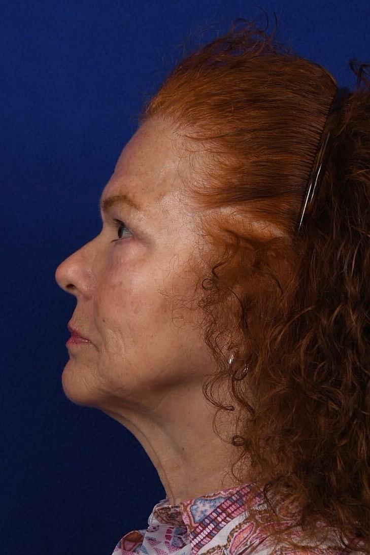Facial Rejuvenation Before & After