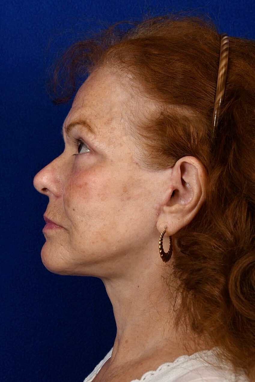 Facial Rejuvenation Before & After