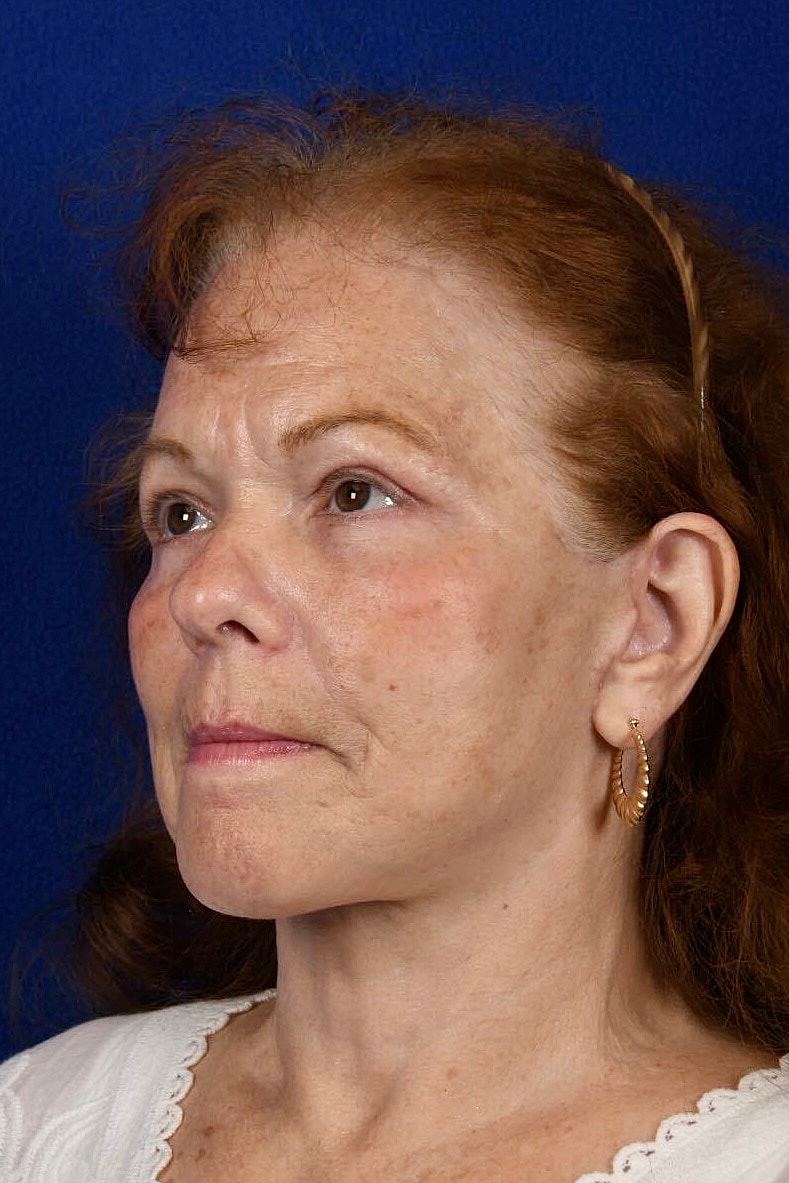 Facial Rejuvenation Before & After