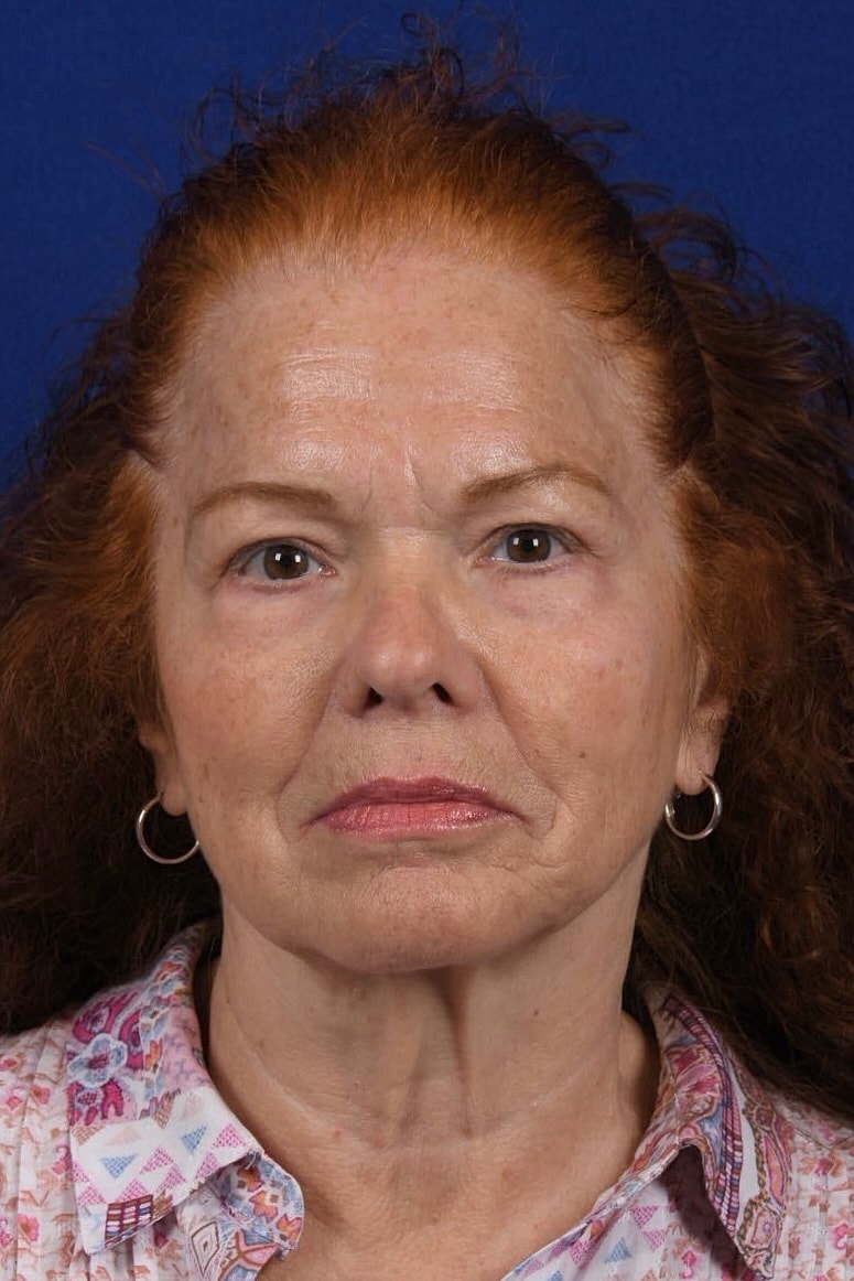 Facial Rejuvenation Before & After