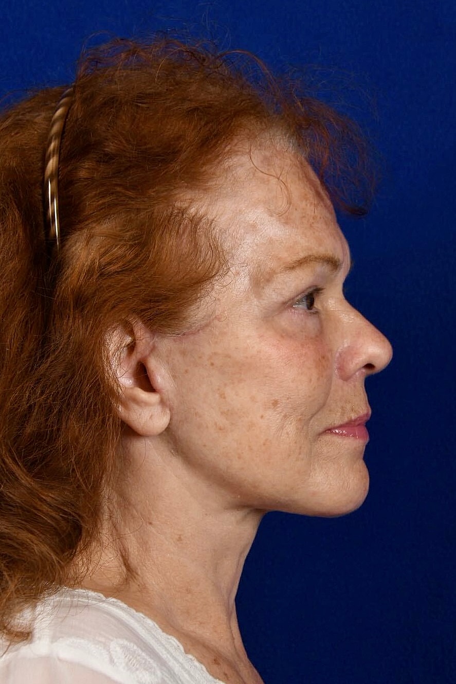 Facial Rejuvenation Before & After