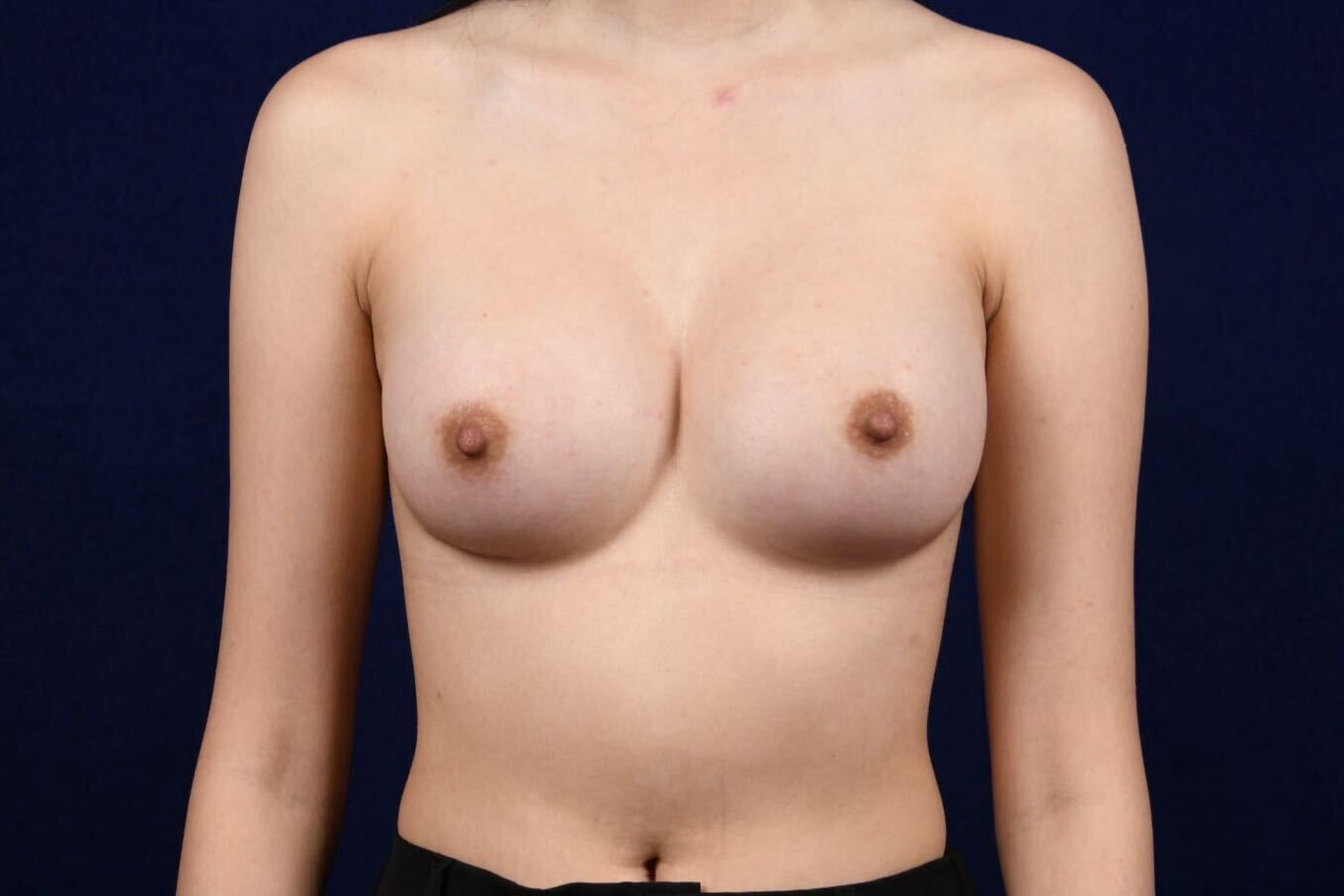 Breast Augmentation Before & After