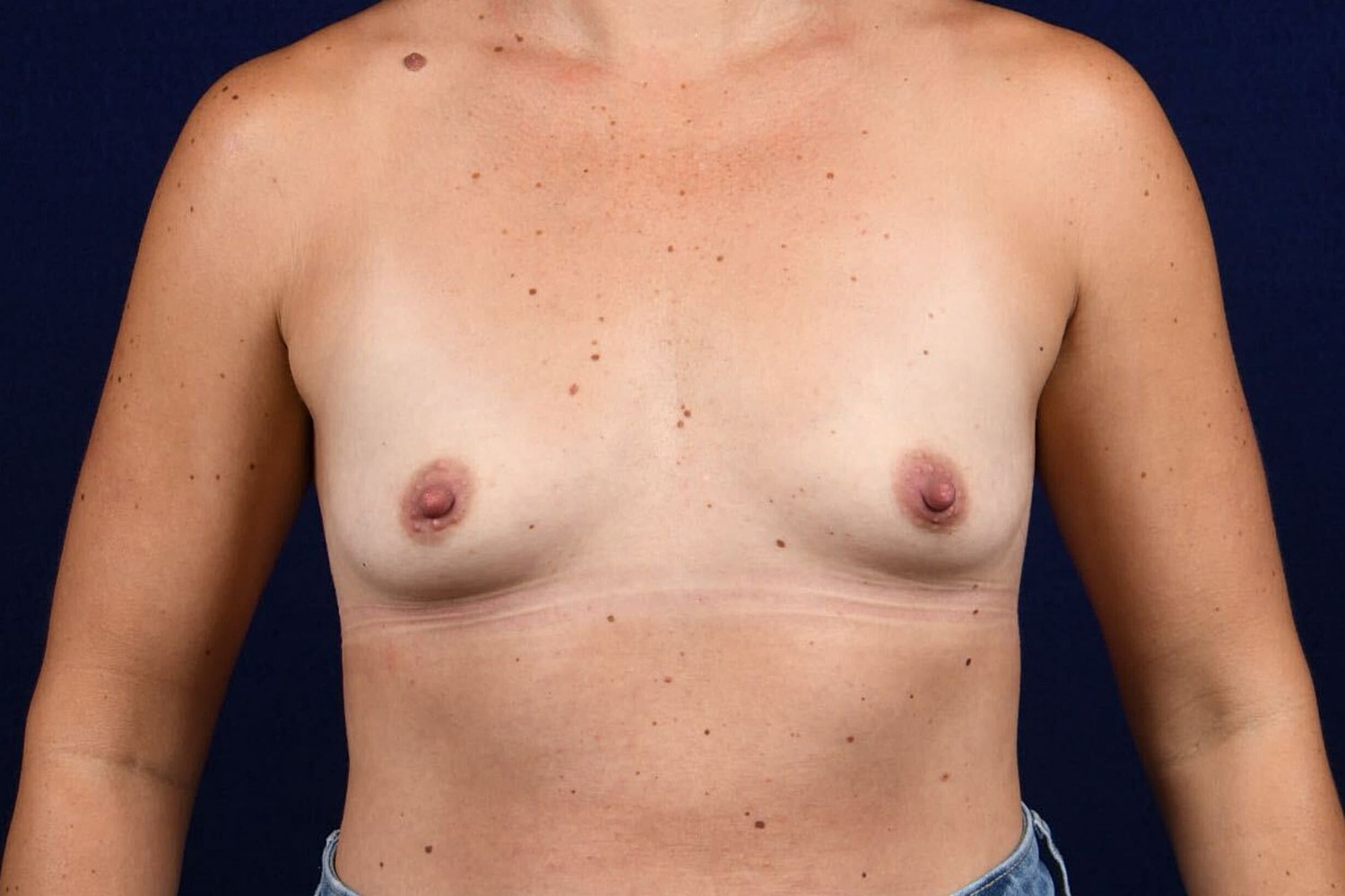 Breast Augmentation Before & After