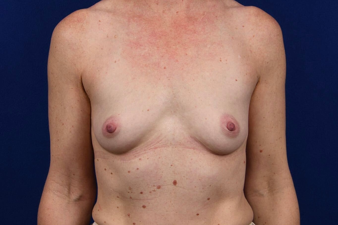 Breast Augmentation Before & After