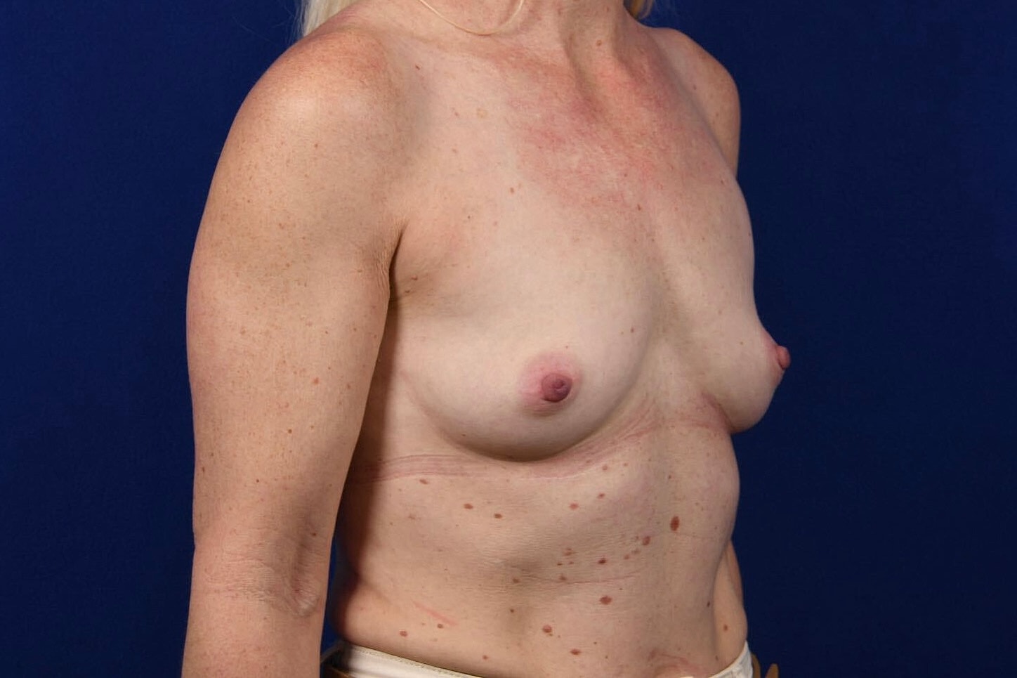 Breast Augmentation Before & After