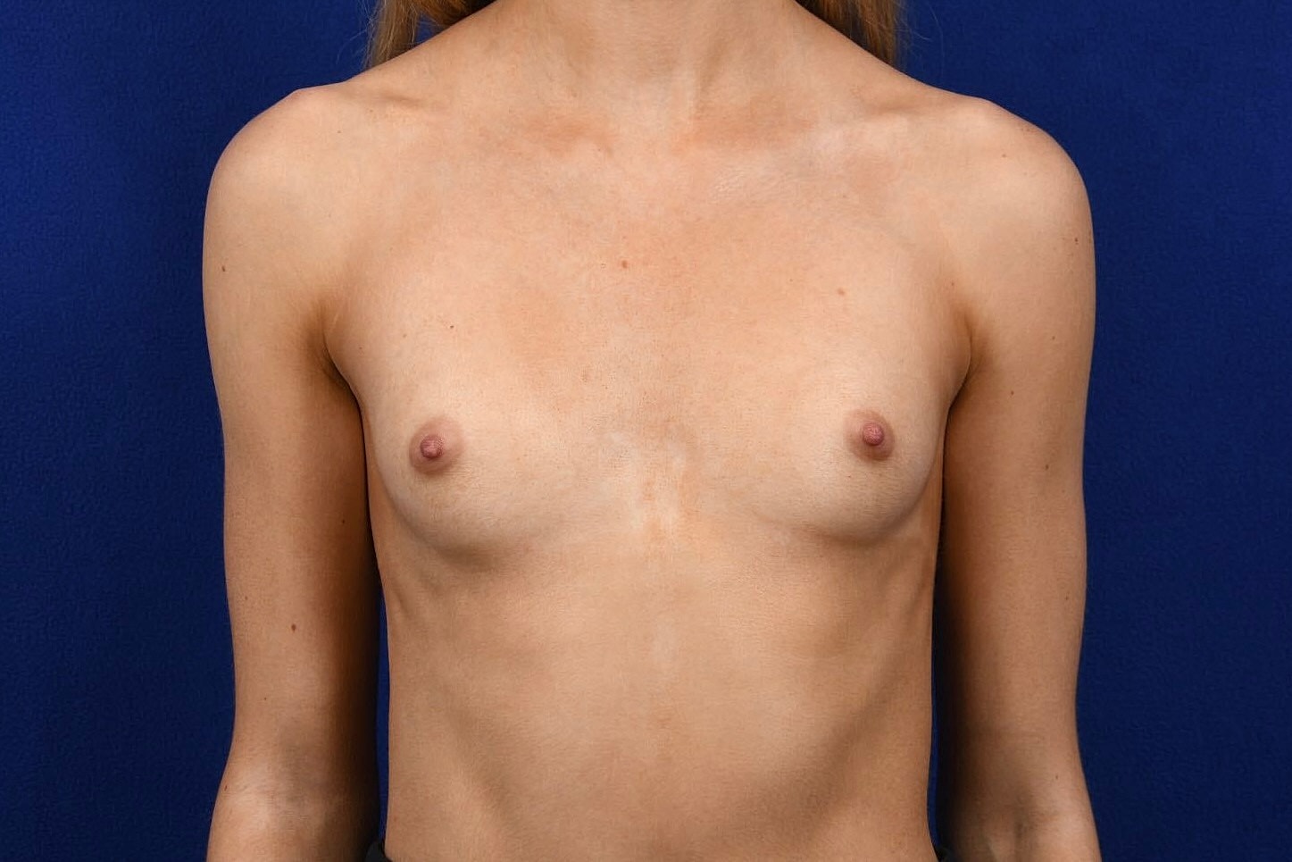 Breast Augmentation Before & After