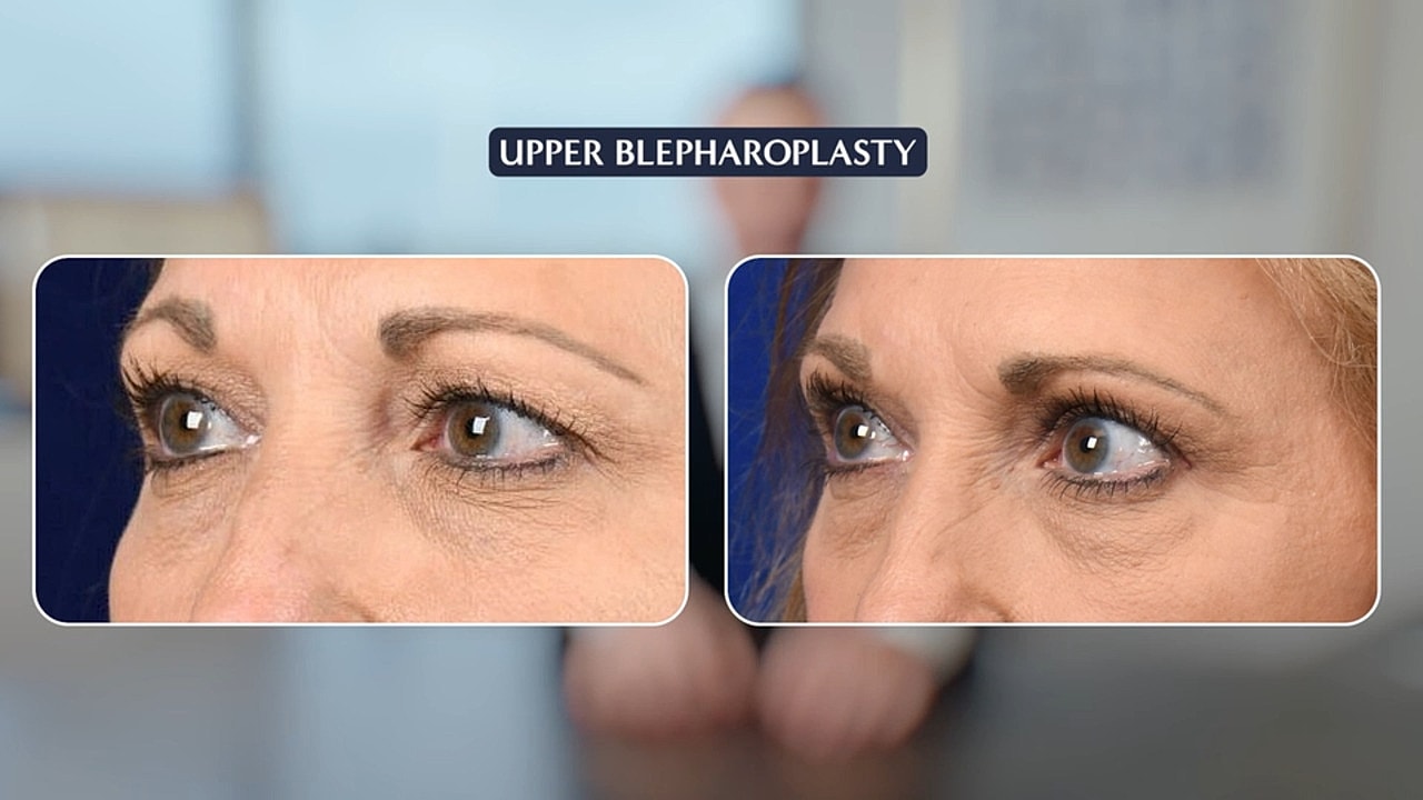 Upper blepharoplasty before and after comparison