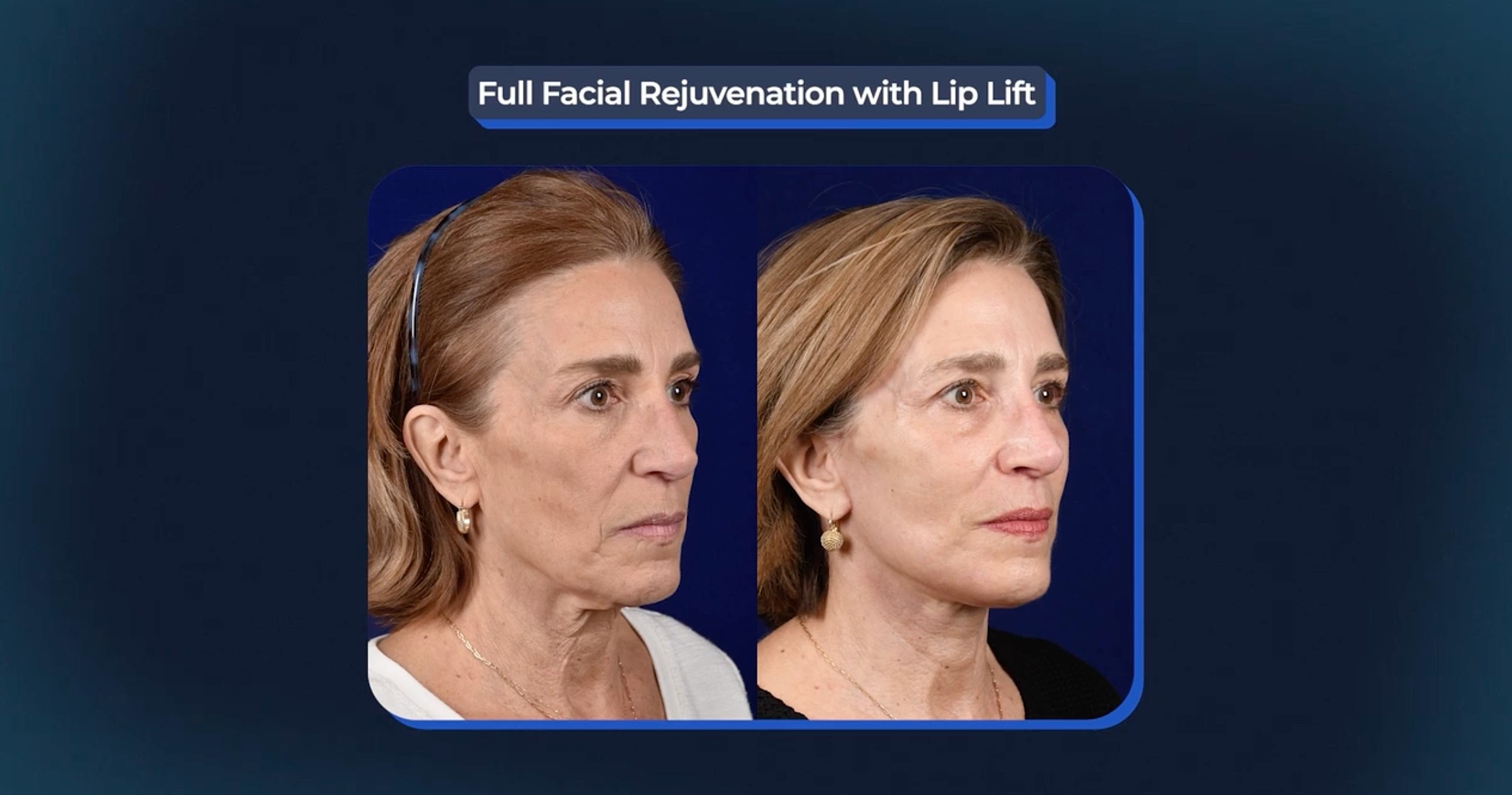 Before and after facial rejuvenation with lip lift.