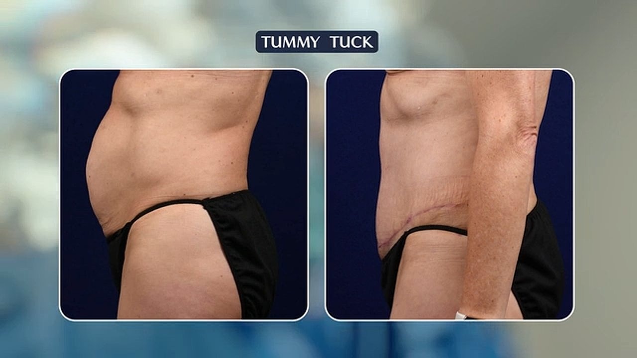 Before and after tummy tuck procedure comparison.